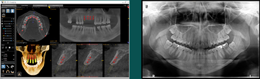 3d CT Scan Result