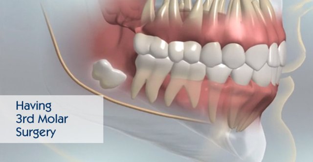 3rd Molar Surgery