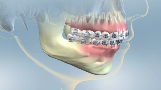 Having Orthognatic Jaw Surgery