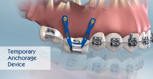 Temporary Anchorage Devices
