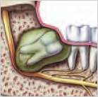 Wisdom Teeth Cysts