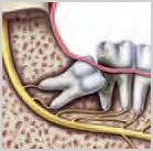 Wisdom Teeth Damage